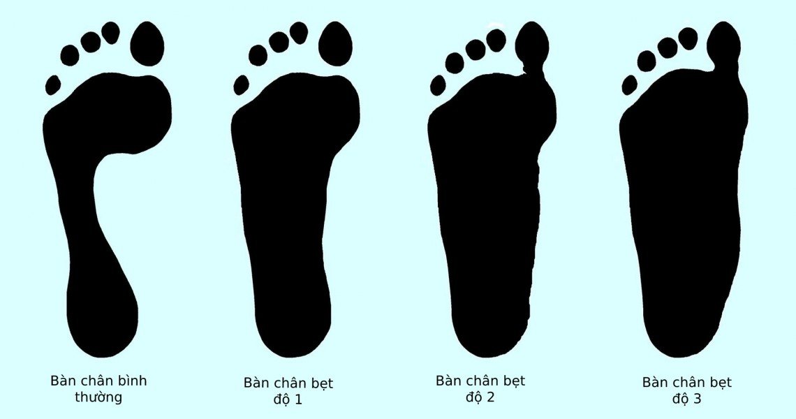 Cách chọn giày theo dáng Chân và Cơ thể Cách chọn giày theo dáng Chân và Cơ thể